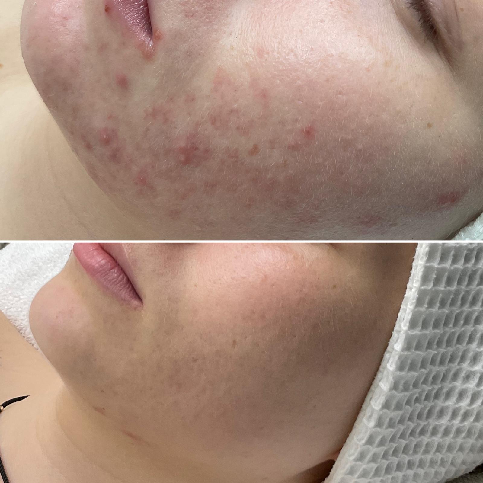 C02-Fractional-laser-2.jpg