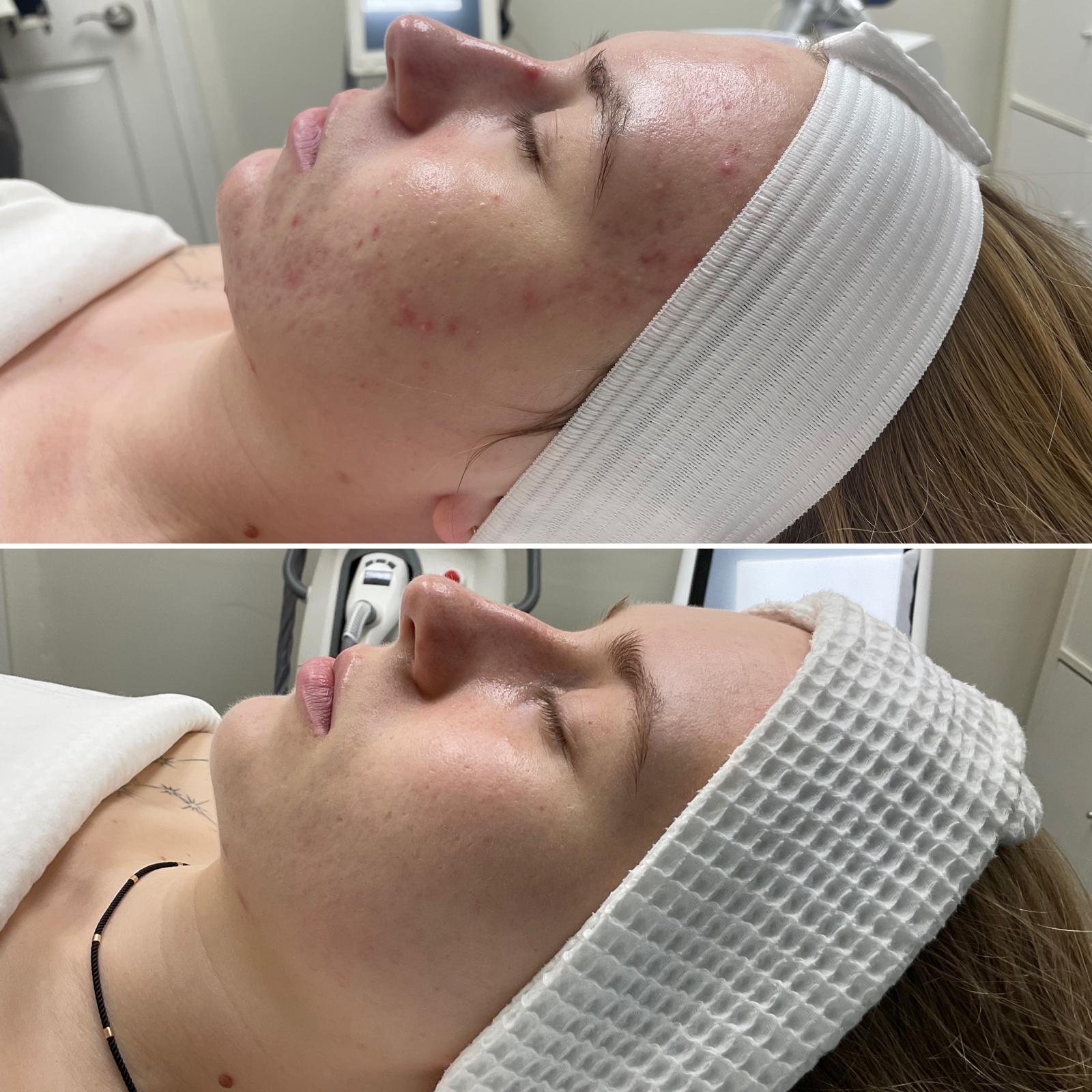 C02-Fractional-laser.jpg