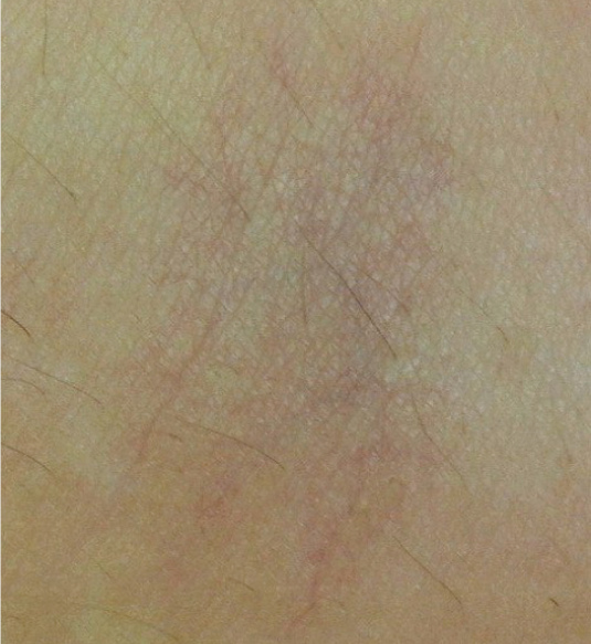 Goo_vascular_after