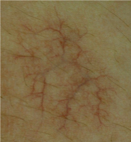 Goo_vascular_before
