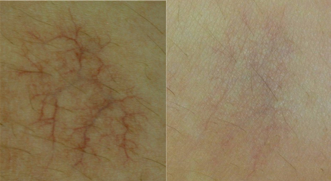 Laser Vascular Lesion Removal Toronto Spider Veins Before After H Gracefully