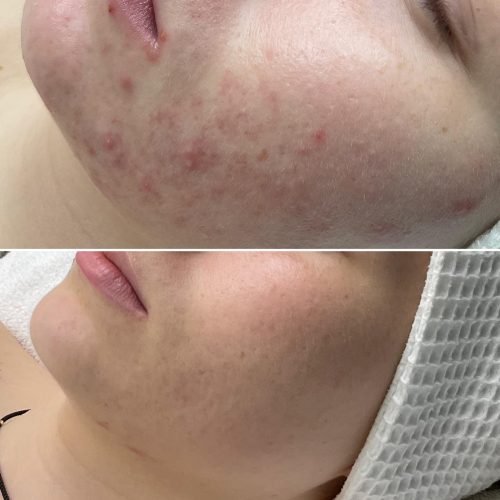 C02 Fractional laser 2