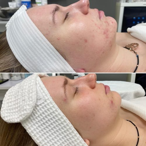 C02 Fractional laser 3