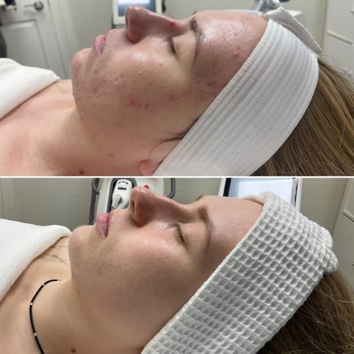 C02 Fractional laser